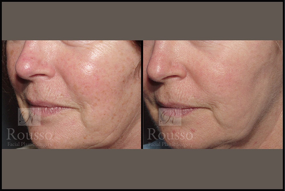 Plasma Skin Resurfacing Before & After Gallery - Patient 147124283 - Image 3