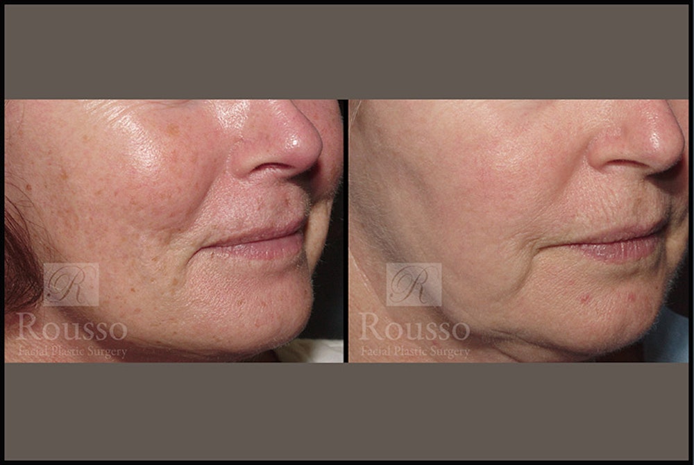 Plasma Skin Resurfacing Before & After Gallery - Patient 147124283 - Image 4