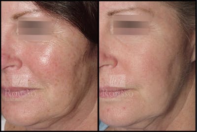 Plasma Skin Resurfacing Before & After Gallery - Patient 4727309 - Image 2
