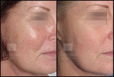Plasma Skin Resurfacing Before & After Gallery - Patient 147124283 - Image 1