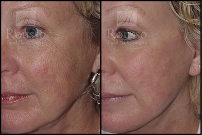 Plasma Skin Resurfacing Before & After Gallery - Patient 4727310 - Image 2