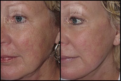 Plasma Skin Resurfacing <span class=small>By Dr. Daniel Rousso</span> Before & After Gallery - Patient 4727310 - Image 2