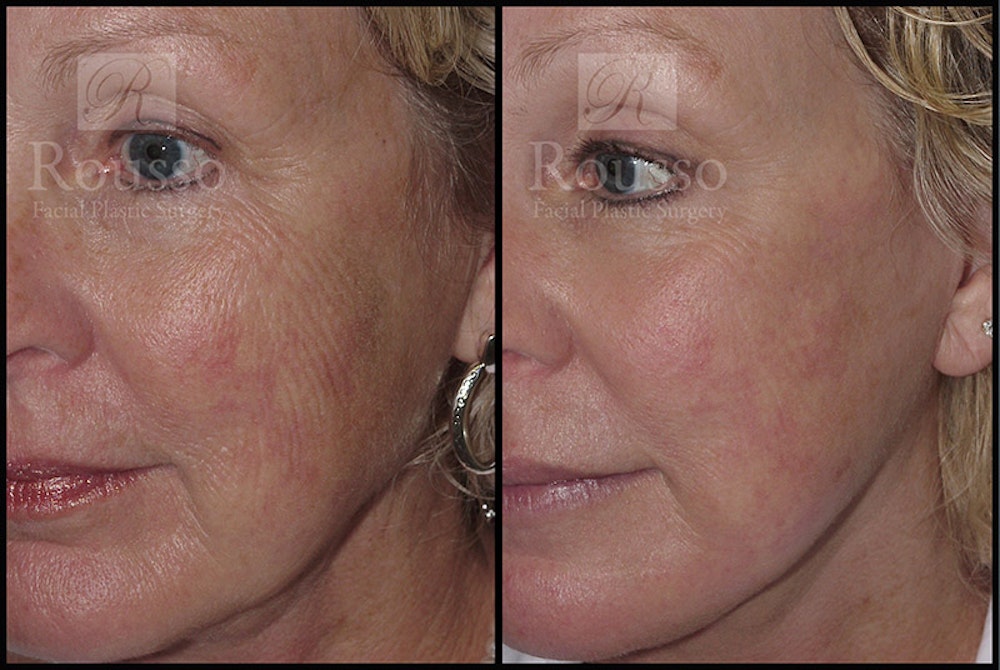 Plasma Skin Resurfacing Before & After Gallery - Patient 4727310 - Image 2