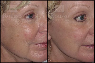 Plasma Skin Resurfacing <span class=small>By Dr. Daniel Rousso</span> Before & After Gallery - Patient 4727310 - Image 1