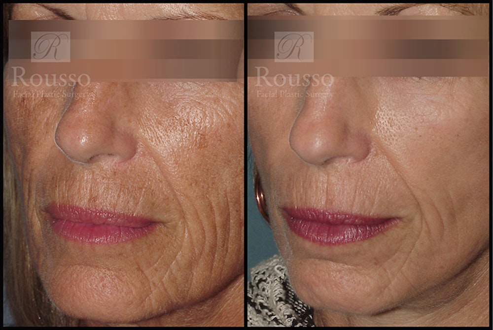 Plasma Skin Resurfacing Before & After Gallery - Patient 147124286 - Image 1