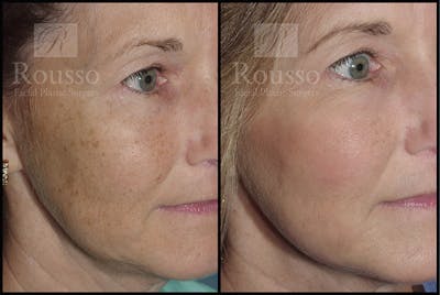 Plasma Skin Resurfacing Before & After Gallery - Patient 147124287 - Image 1