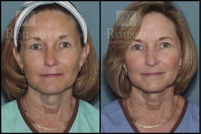 Plasma Skin Resurfacing Before & After Gallery - Patient 147124287 - Image 2