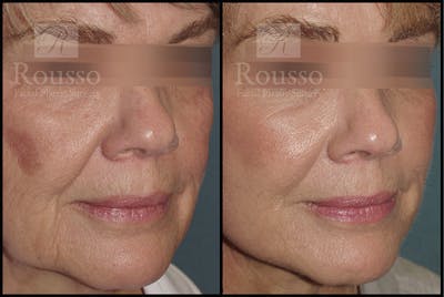 Plasma Skin Resurfacing Before & After Gallery - Patient 4727313 - Image 1
