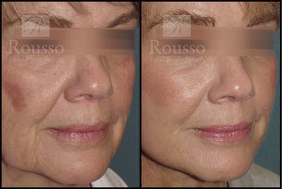 Plasma Skin Resurfacing Before & After Gallery - Patient 147124288 - Image 1