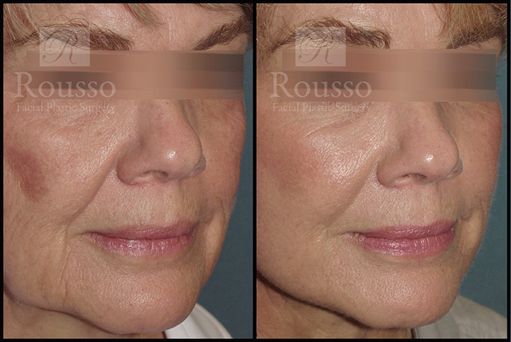 Plasma Skin Resurfacing Before & After Gallery - Patient 147124288 - Image 1