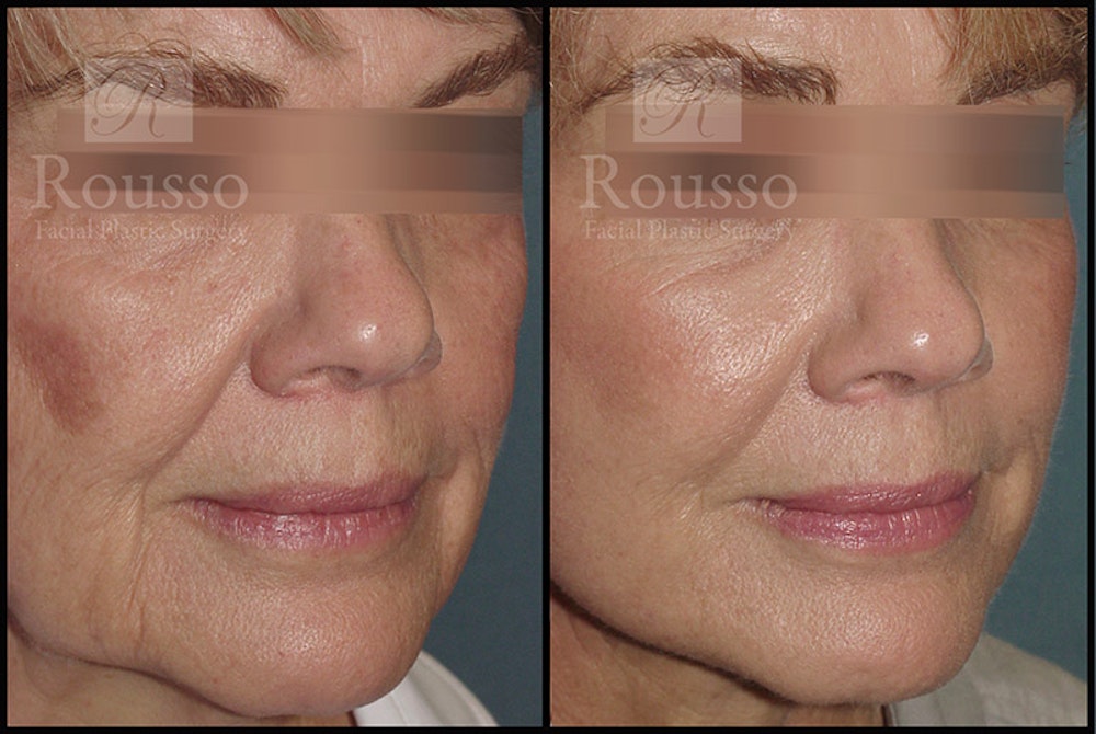 Plasma Skin Resurfacing Before & After Gallery - Patient 4727313 - Image 1