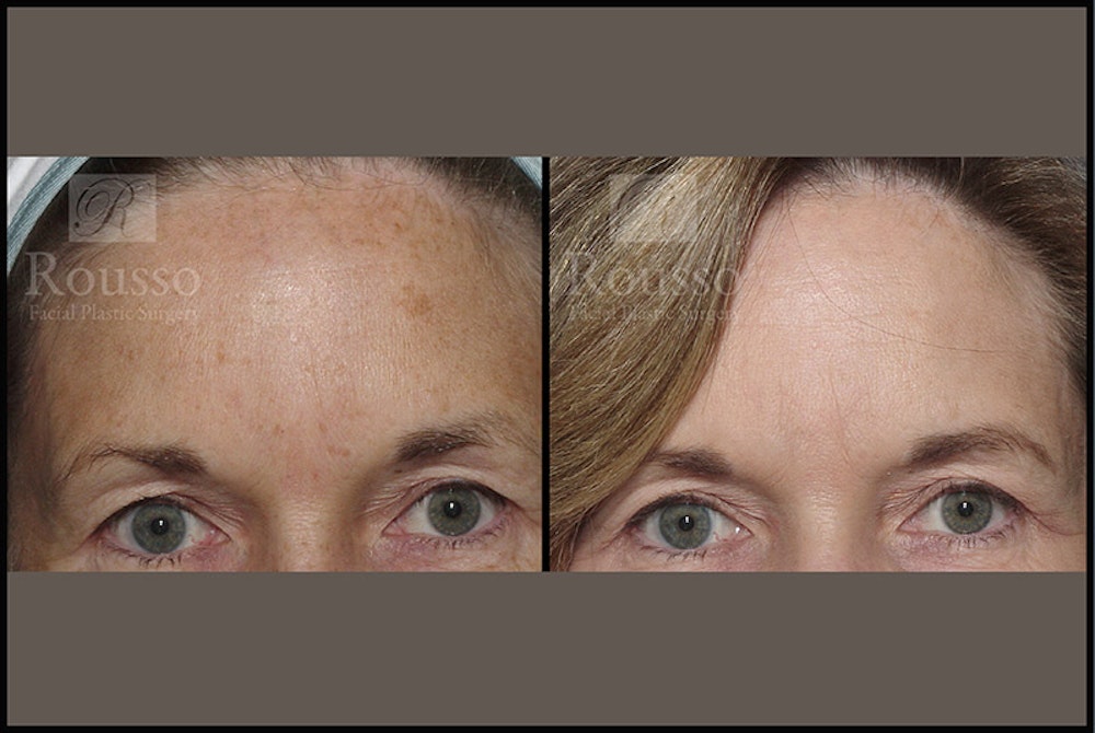 Plasma Skin Resurfacing <span class=small>By Dr. Daniel Rousso</span> Before & After Gallery - Patient 4727312 - Image 3