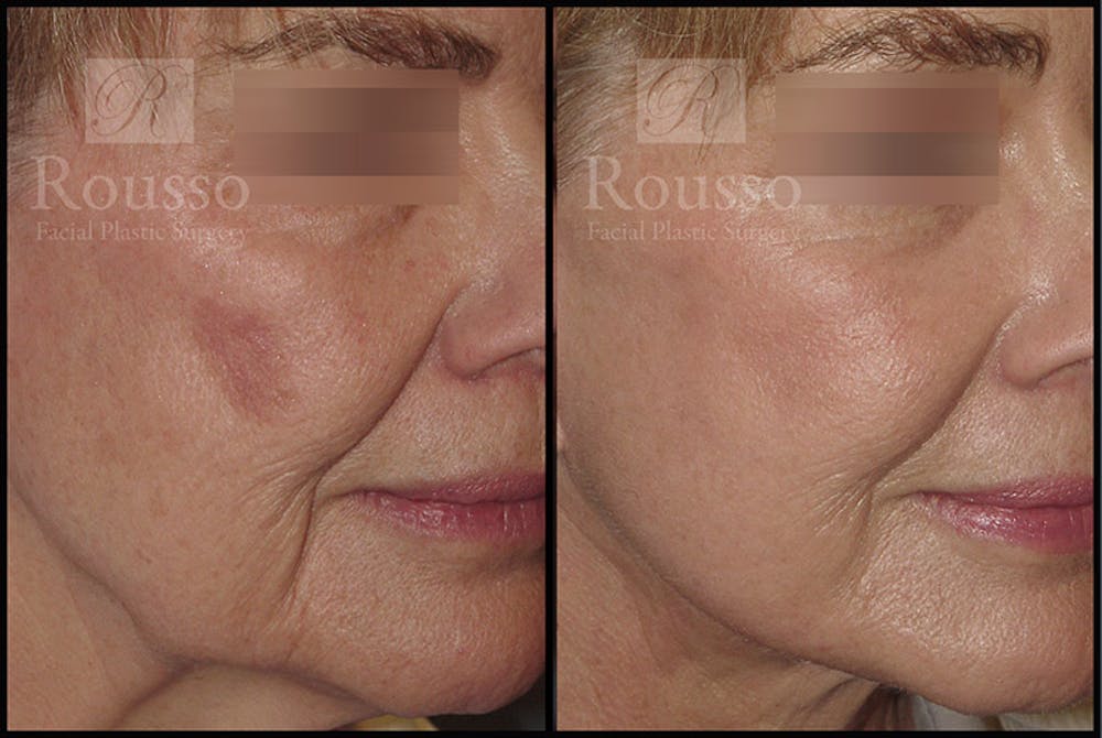 Plasma Skin Resurfacing Gallery - Patient 4727313 - Image 2