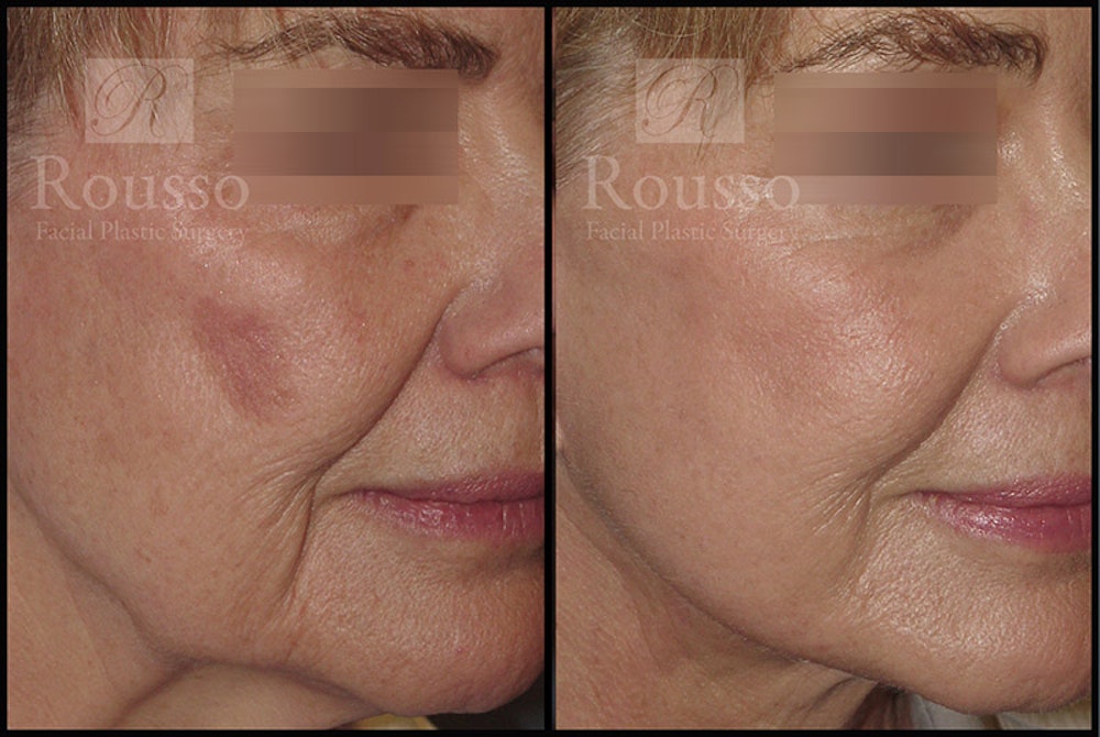 Plasma Skin Resurfacing Before & After Gallery - Patient 147124288 - Image 2
