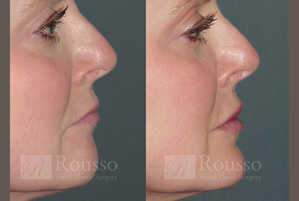 Fillers Before & After Gallery - Patient 4820321 - Image 1