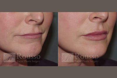 Fillers Before & After Gallery - Patient 4820322 - Image 1