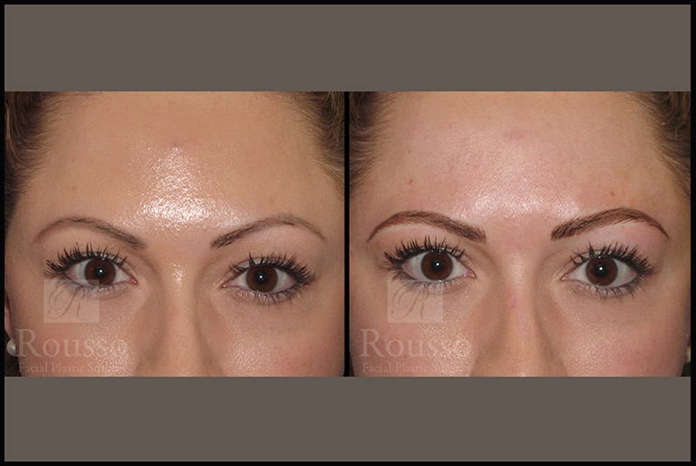 Microblading Gallery - Patient 4890746 - Image 1