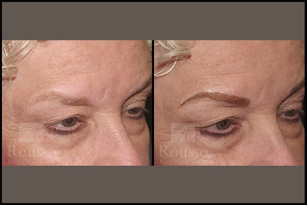 Microblading Before & After Gallery - Patient 4890747 - Image 1