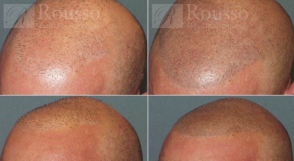 Scalp MicroPigmentation Before & After Gallery - Patient 5334965 - Image 1