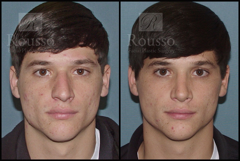 Rhinoplasty <span class=small>By Dr. Daniel Rousso</span> Before & After Gallery - Patient 1993322 - Image 3