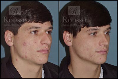 Rhinoplasty <span class=small>By Dr. Daniel Rousso</span> Before & After Gallery - Patient 1993322 - Image 2