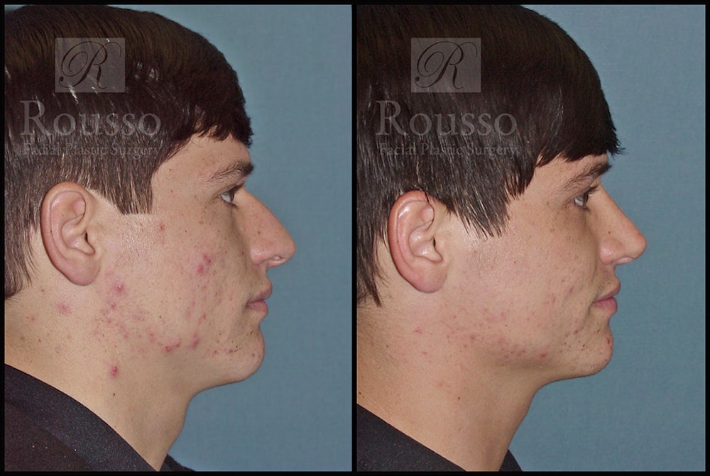 Rhinoplasty Before & After Gallery - Patient 1993322 - Image 3