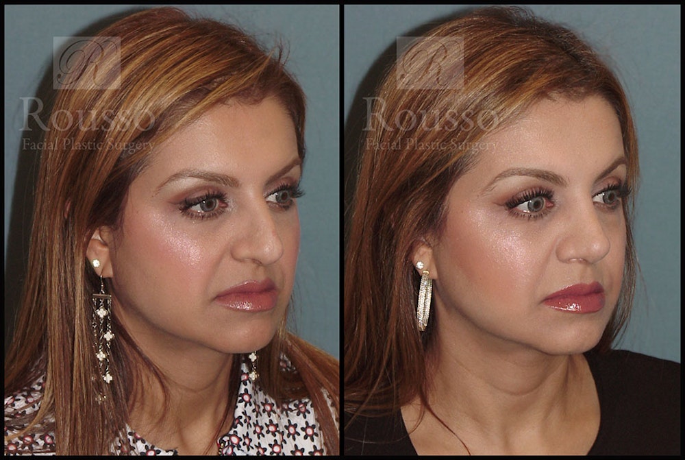 Rhinoplasty <span class=small>By Dr. Daniel Rousso</span> Before & After Gallery - Patient 5776413 - Image 2