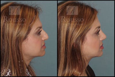 Rhinoplasty <span class=small>By Dr. Daniel Rousso</span> Before & After Gallery - Patient 5776413 - Image 1