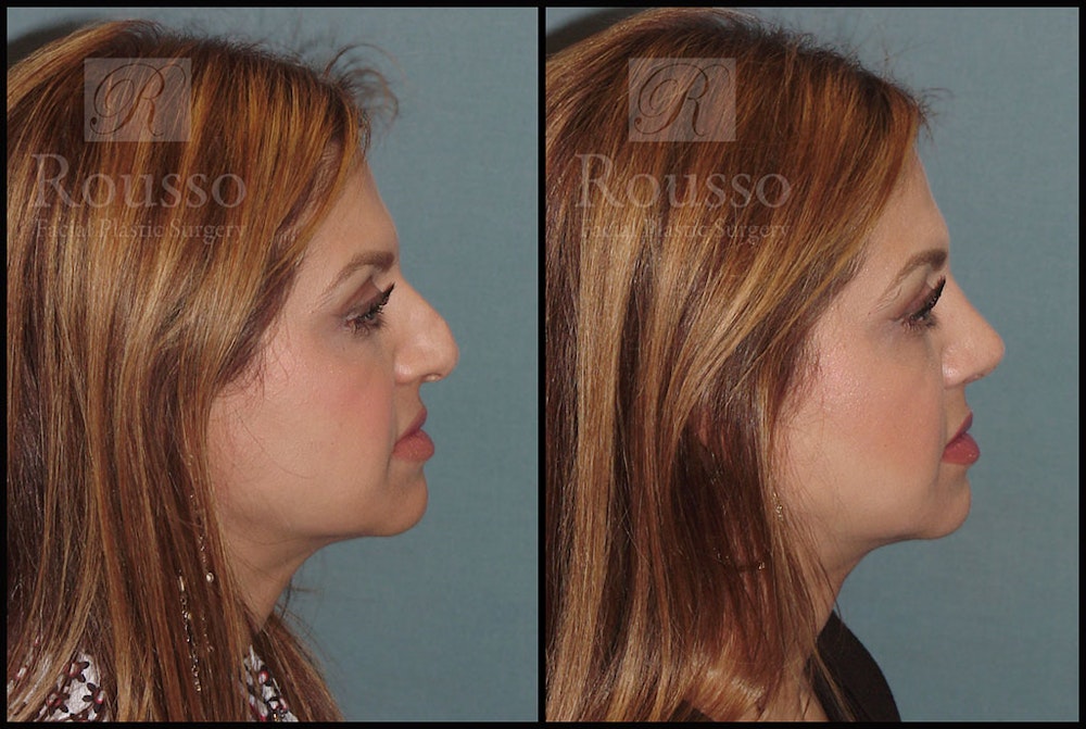 Rhinoplasty <span class=small>By Dr. Daniel Rousso</span> Before & After Gallery - Patient 5776413 - Image 1