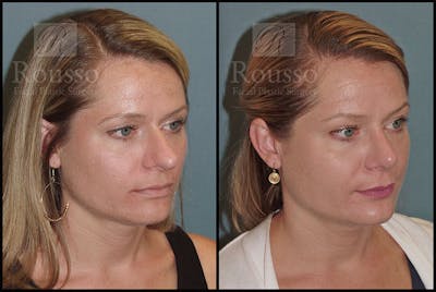 Rhinoplasty <span class=small>By Dr. Daniel Rousso</span> Before & After Gallery - Patient 5776414 - Image 2