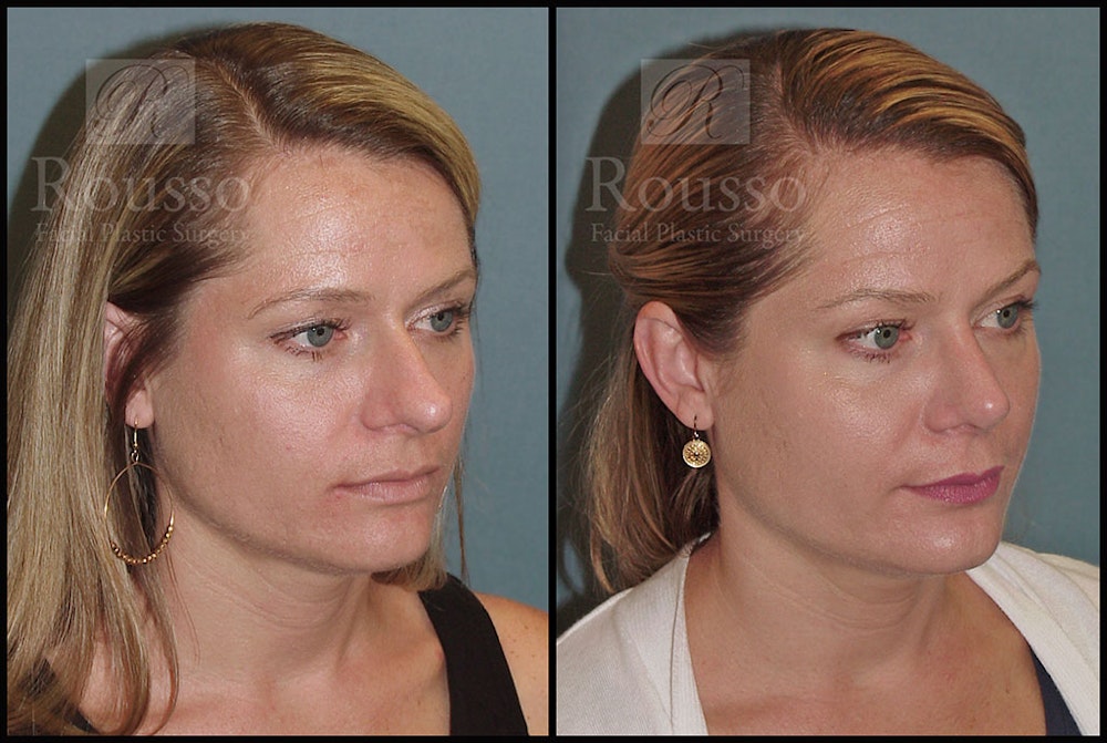 Rhinoplasty Before & After Gallery - Patient 5776414 - Image 2