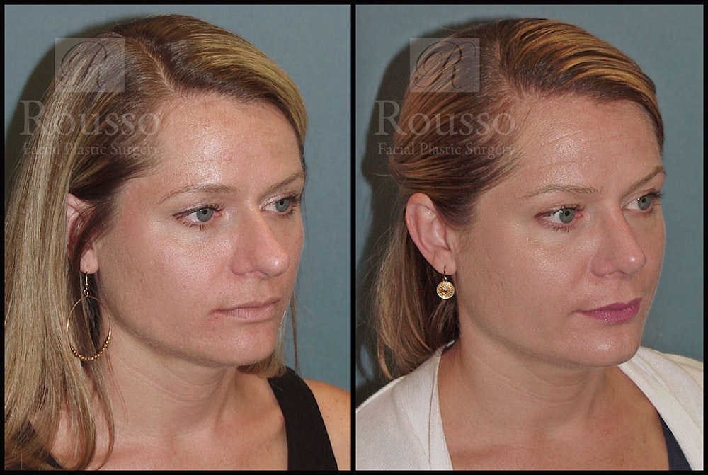 Rhinoplasty <span class=small>By Dr. Daniel Rousso</span> Before & After Gallery - Patient 5776414 - Image 2
