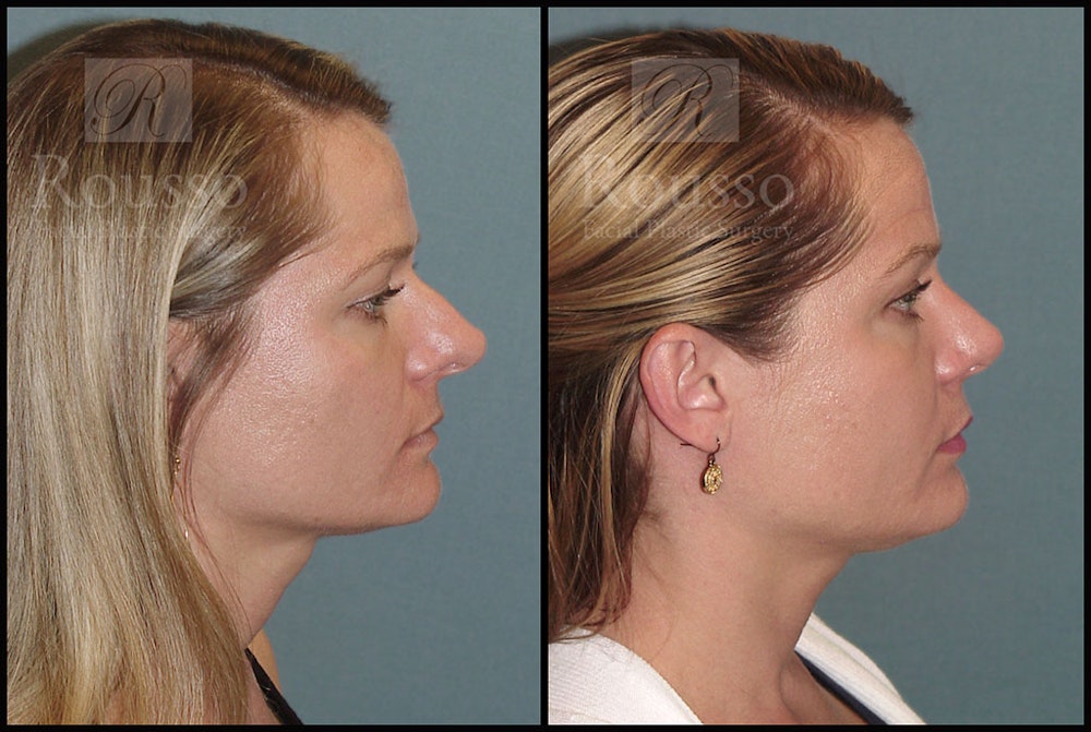 Rhinoplasty <span class=small>By Dr. Daniel Rousso</span> Before & After Gallery - Patient 5776414 - Image 1