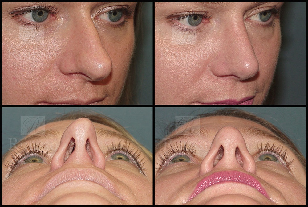 Rhinoplasty <span class=small>By Dr. Daniel Rousso</span> Before & After Gallery - Patient 5776414 - Image 3