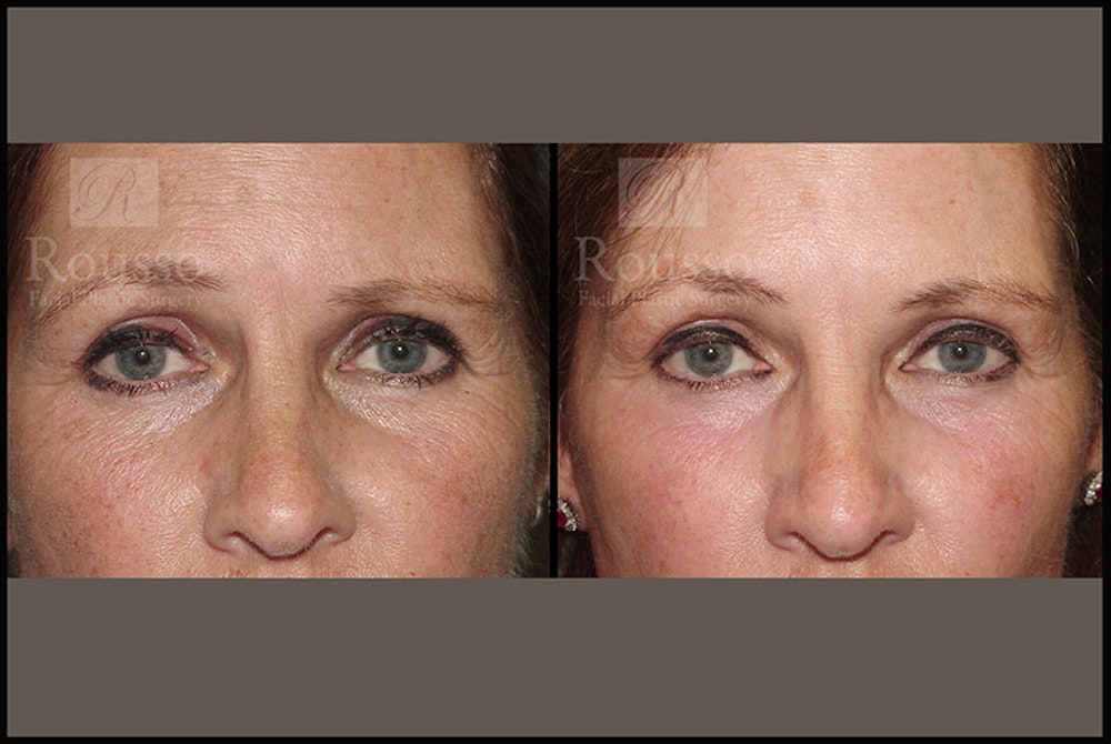 Plasma Skin Resurfacing <span class=small>By Dr. Daniel Rousso</span> Before & After Gallery - Patient 5818918 - Image 3