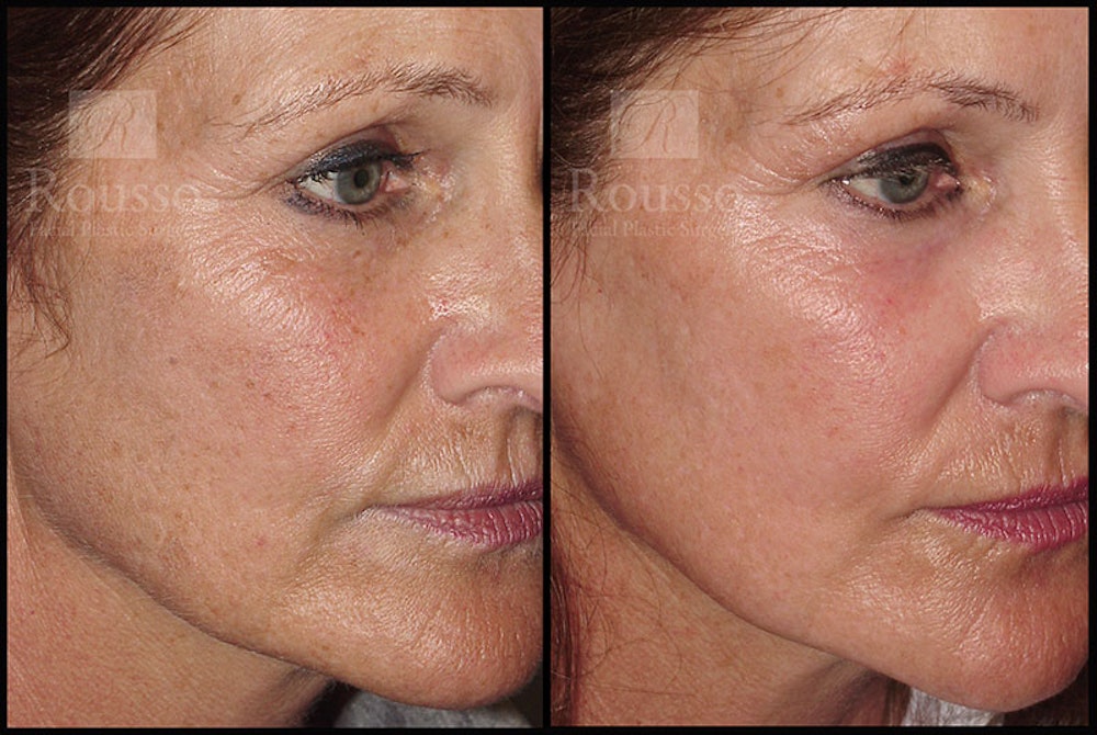 Plasma Skin Resurfacing <span class=small>By Dr. Daniel Rousso</span> Before & After Gallery - Patient 5818918 - Image 1