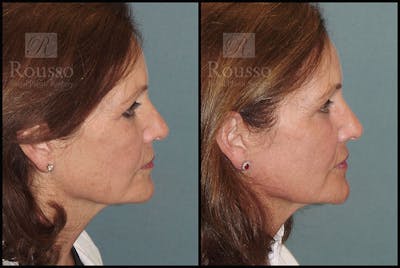 Plasma Skin Resurfacing Before & After Gallery - Patient 5818918 - Image 2