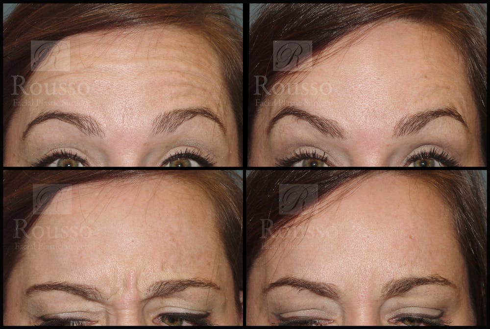 Botox in Birmingham & Montgomery AL Before & After Photos