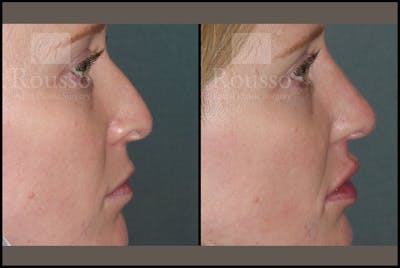 Non-Surgical Rhinoplasty Gallery - Patient 6363742 - Image 1