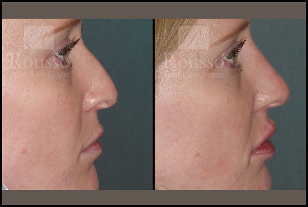 Liquid Rhinoplasty Before & After Gallery - Patient 6363742 - Image 1