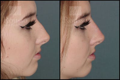 Liquid Rhinoplasty Before & After Gallery - Patient 6364282 - Image 1