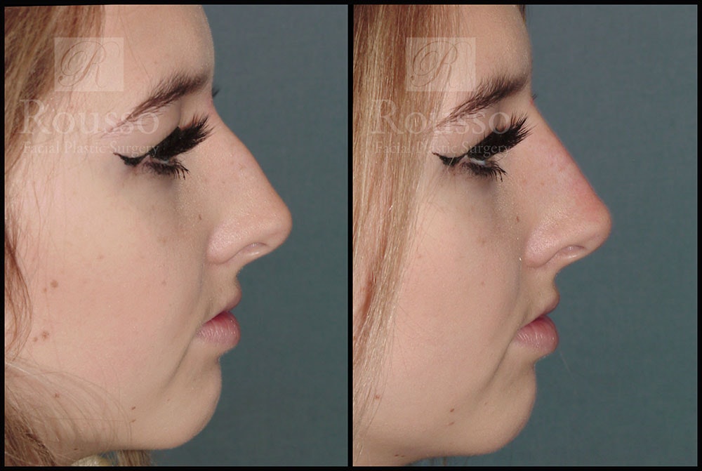 Liquid Rhinoplasty Before & After Gallery - Patient 6364282 - Image 1