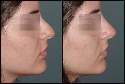 Liquid Rhinoplasty Gallery Before & After Gallery - Patient 6364283 - Image 1