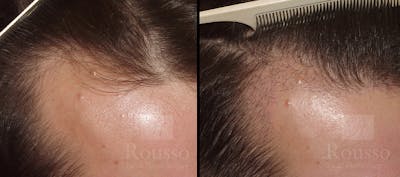Hair Transplant Before & After Gallery - Patient 7300730 - Image 1