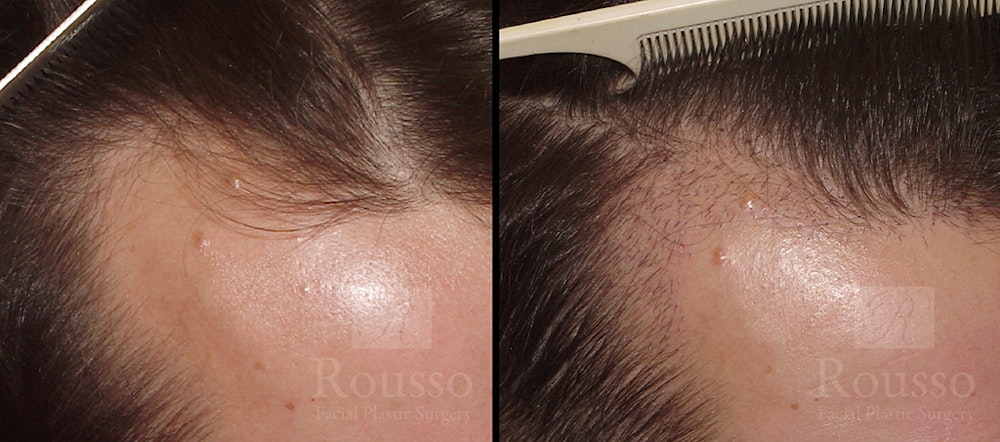 Hair Transplant Before & After Gallery - Patient 7300730 - Image 1