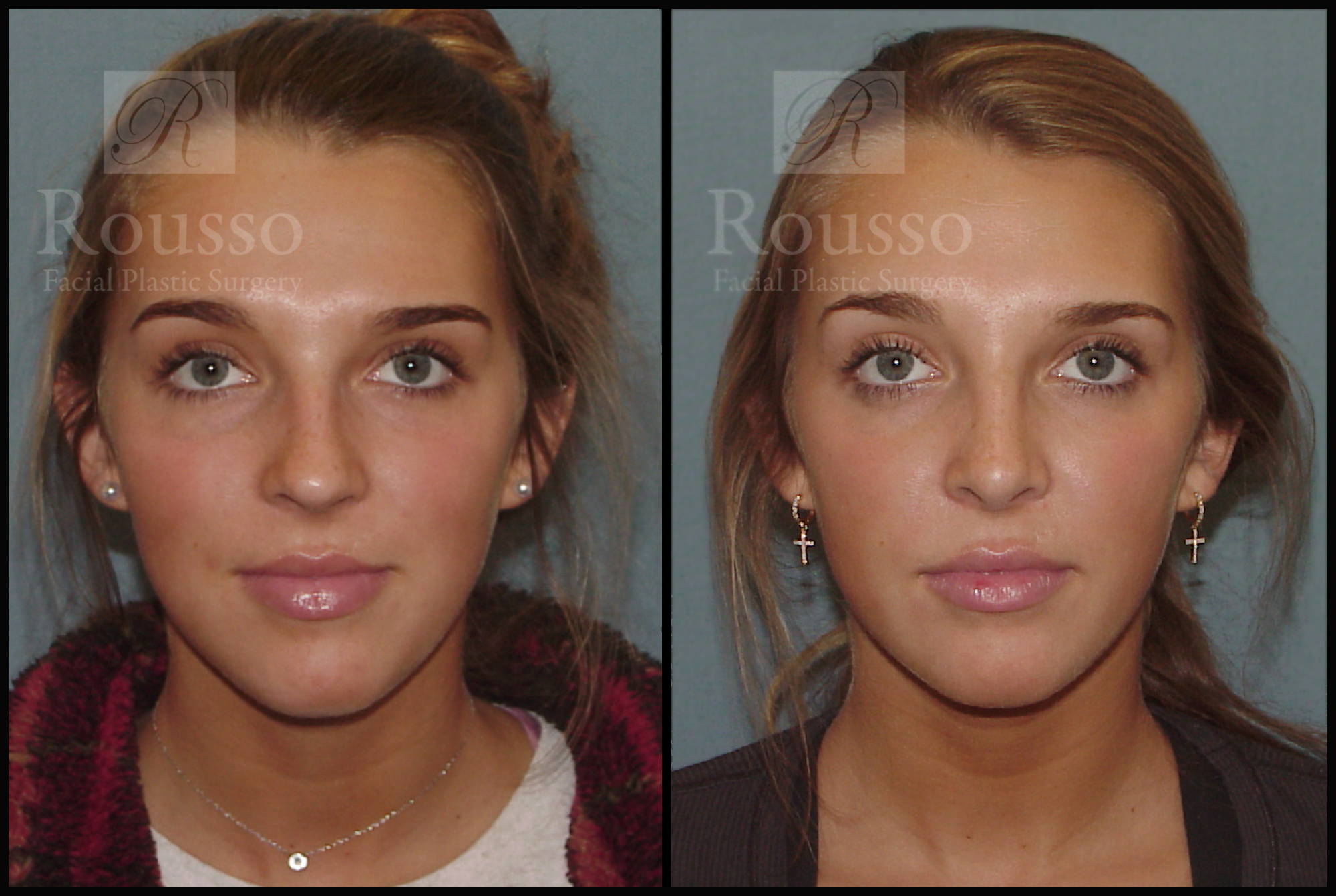 good nose job before and after