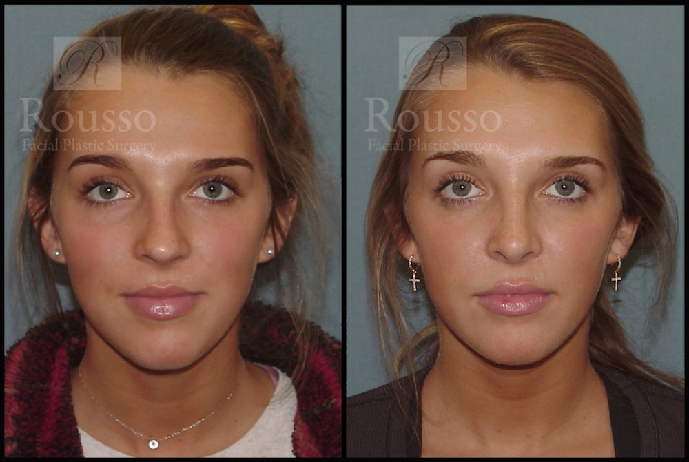 Rhinoplasty Before & After Gallery - Patient 7392509 - Image 2