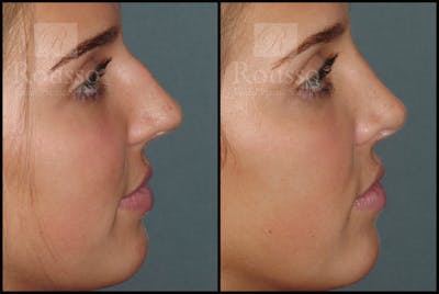 Rhinoplasty <span class=small>By Dr. Daniel Rousso</span> Before & After Gallery - Patient 7392509 - Image 4