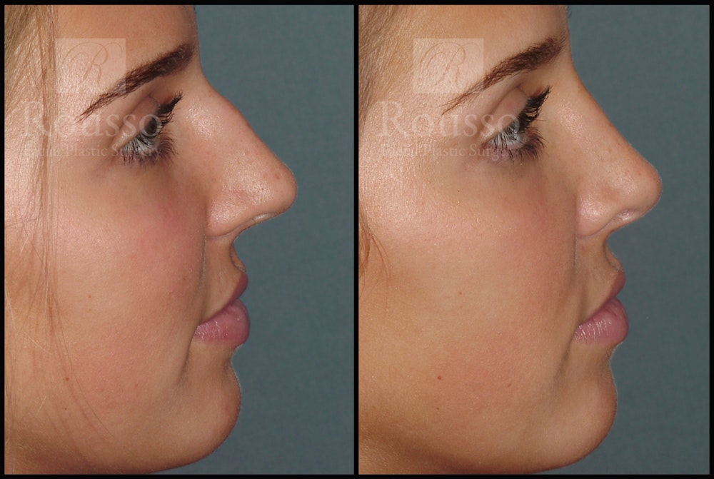 Rhinoplasty <span class=small>By Dr. Daniel Rousso</span> Before & After Gallery - Patient 7392509 - Image 4