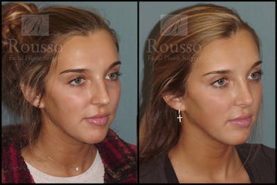 Rhinoplasty <span class=small>By Dr. Daniel Rousso</span> Before & After Gallery - Patient 7392509 - Image 2
